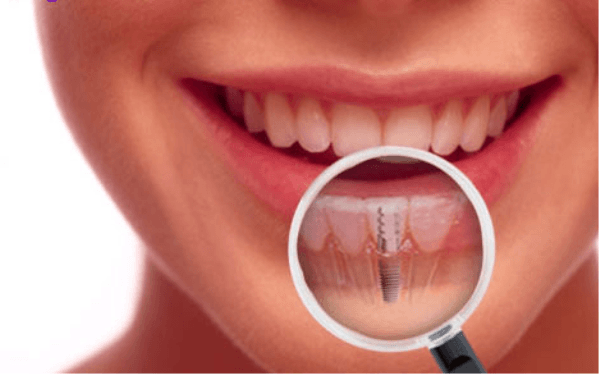 implante dental joven